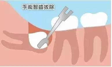 拔完智齿多久能够刷牙洞,拔完智齿的洞多久能长好