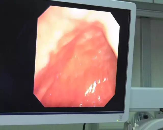 哪些人必须要做胃镜,什么样的人要做胃镜