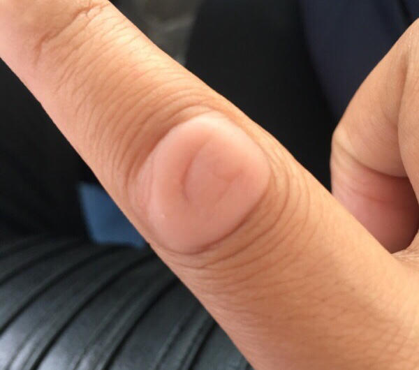 长在关节上的扁平的软软的疙瘩是啥病呢？