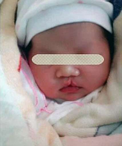 唇腭裂和兔唇四维提示什么,b超显示胎儿偏大一周会提前生吗