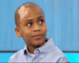 白癜风的人睡过的被子传染不,请问行家白癜风会传染吗