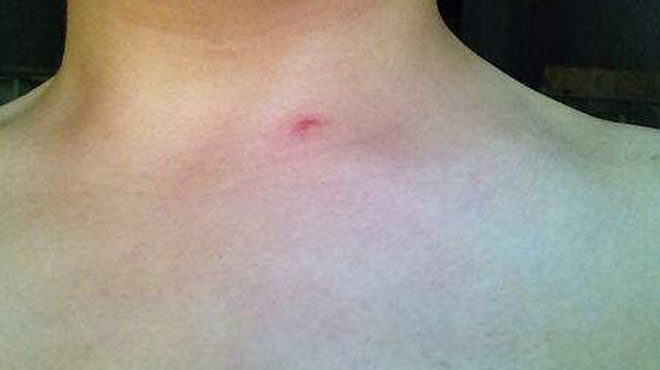 肝部位长红痣是什么原因不痛不痒,身上长红痣是肝出现问题了吗