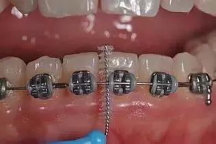 儿童口腔科正畸多大能够做,口腔戴牙套需要无菌操作么