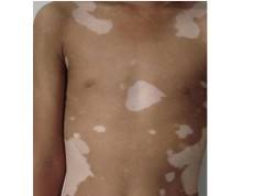 白癜风的人睡过的被子传染不,请问行家白癜风会传染吗