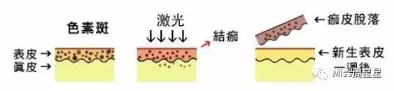 iluminagelaser美容仪,紧致去皱美白美容仪