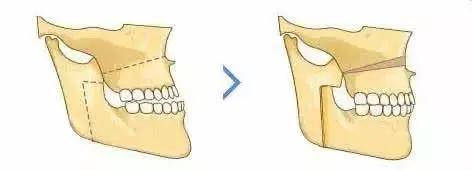 儿童口腔科正畸多大能够做,口腔戴牙套需要无菌操作么