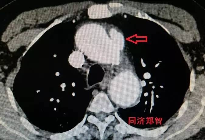 主动脉夹层差点要了老公的命,主动脉夹层兄妹