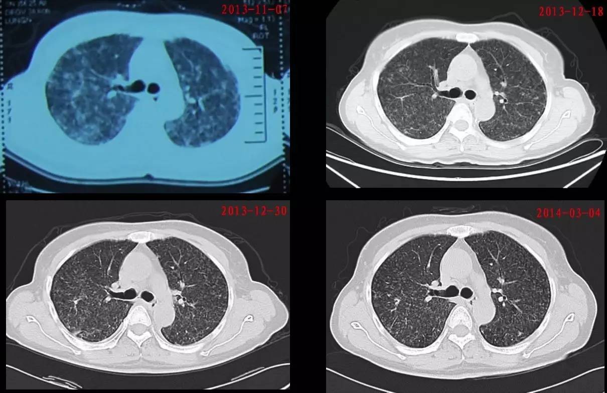 喘息、呼衰1年，问病史才发现是这个病！