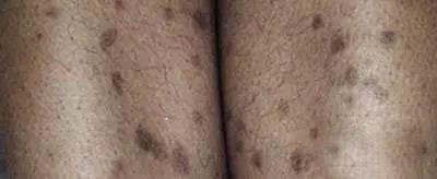 痘印区分,怎样判断自己是痘印还是痘坑