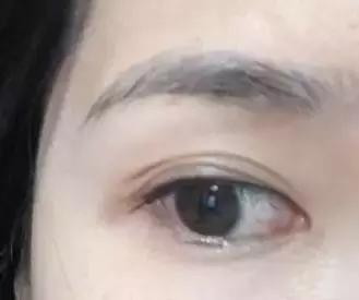 拯救三眼皮的方法,术后出现三眼皮算手术失败吗