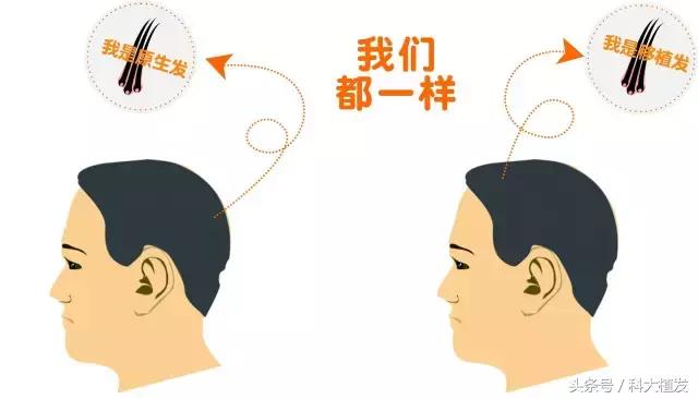 移植后的头发和正常头发有多大区别？