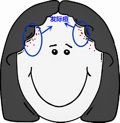 脸部痘痘看身体状况,超全面面部痘痘分析图文