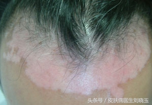 行家剖析白癜风的病因,白癜风患者查明病因的重要性