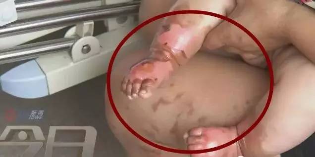 小孩子双脚皮肤溃烂,小孩腿上圆形溃烂化脓怎么回事