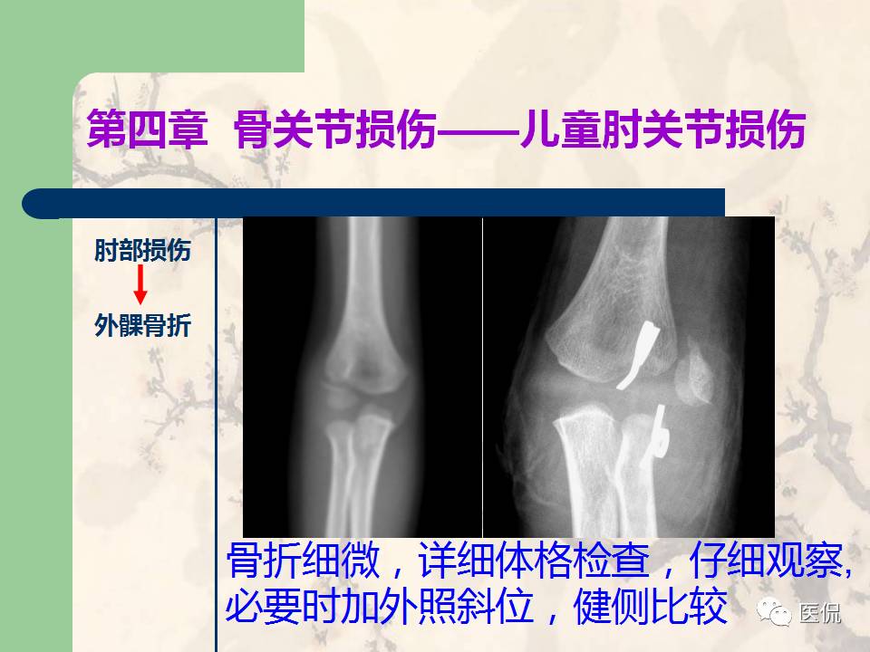 骨关节创伤x线诊断图谱,骨关节损伤x线图