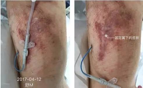 敷料致接触性皮炎，护士这样换药处理，效果极佳！