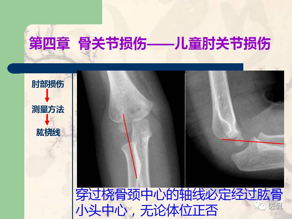 骨关节创伤x线诊断图谱,骨关节损伤x线图