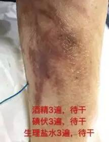 敷料致接触性皮炎，护士这样换药处理，效果极佳！