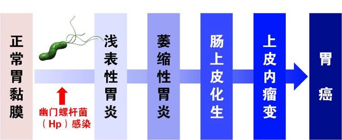 体检的胃功能三项能查出胃癌吗,胃功能三项怎么算胃癌早期