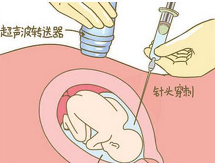 四种孕妇必须做羊水穿刺,羊水穿刺什么情况下孕妇需要做