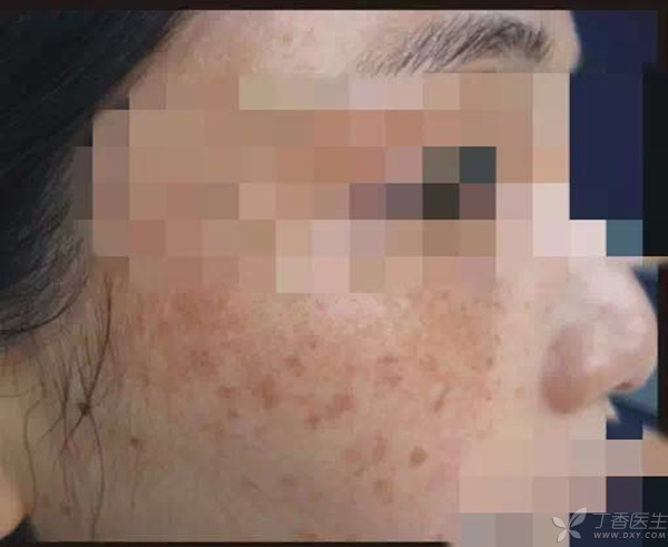 脸上长斑应该如何调理才能祛斑,脸上长斑最有效的祛斑方法