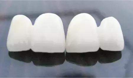 我的烤瓷牙,我的烤瓷牙20年了