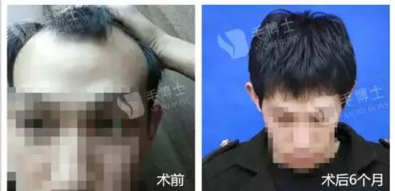 遗传性脱发有什么治疗方法,遗传性脱发用米诺地尔有效吗