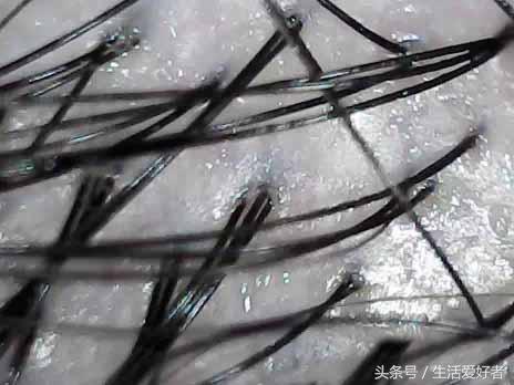 拔伤了毛囊怎么样促进毛囊生发,什么样的毛囊能够生发