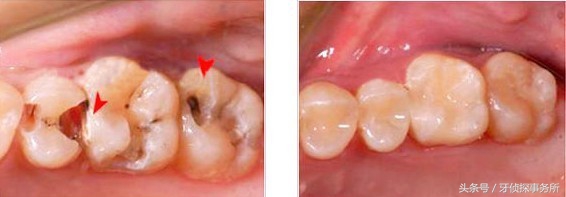 纳米补牙和树脂补牙区别,自己用补牙材料补牙