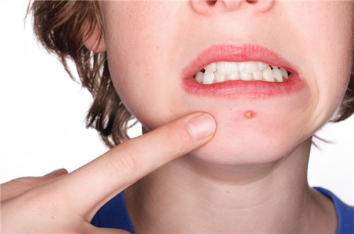 挤完痘痘能够抹精华吗,挤完痘痘能够抹其他皮肤吗