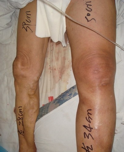 静脉血栓栓塞预防和治疗行家共识,静脉血栓防治的题目