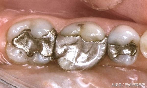 纳米补牙和树脂补牙区别,自己用补牙材料补牙