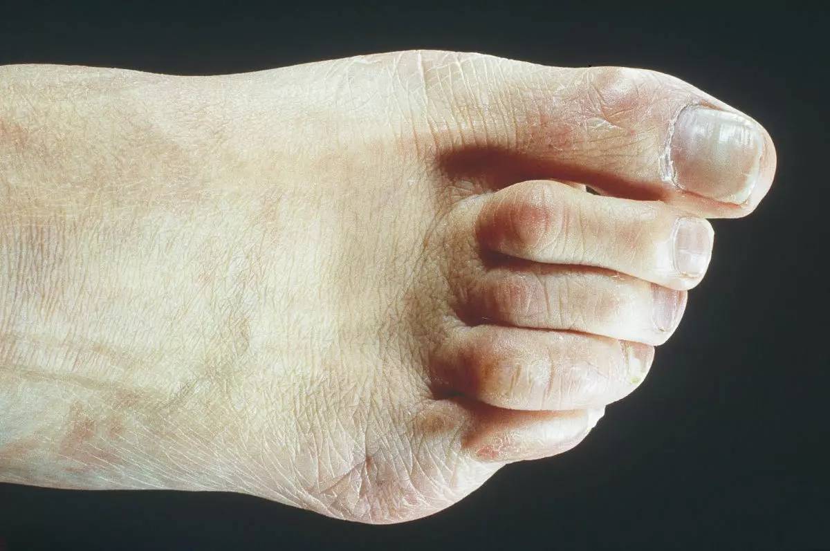 鞋子顶脚痛怎么处理,鞋子短顶脚怎么办