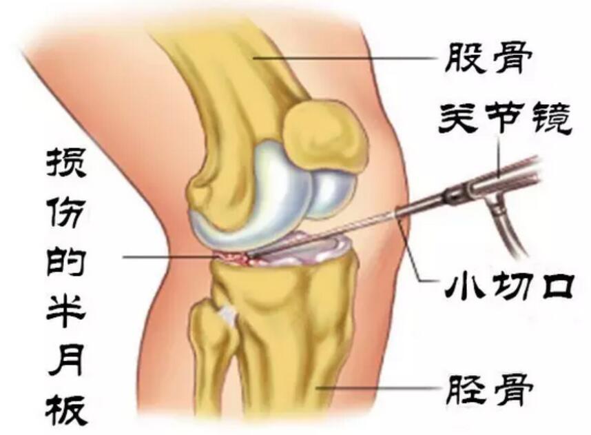膝盖疼半月板损伤用什么药,老人膝盖半月板损伤怎么办