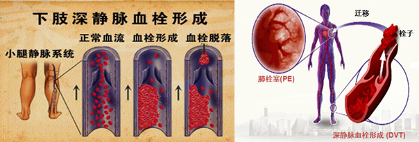 静脉血栓栓塞预防和治疗行家共识,静脉血栓防治的题目