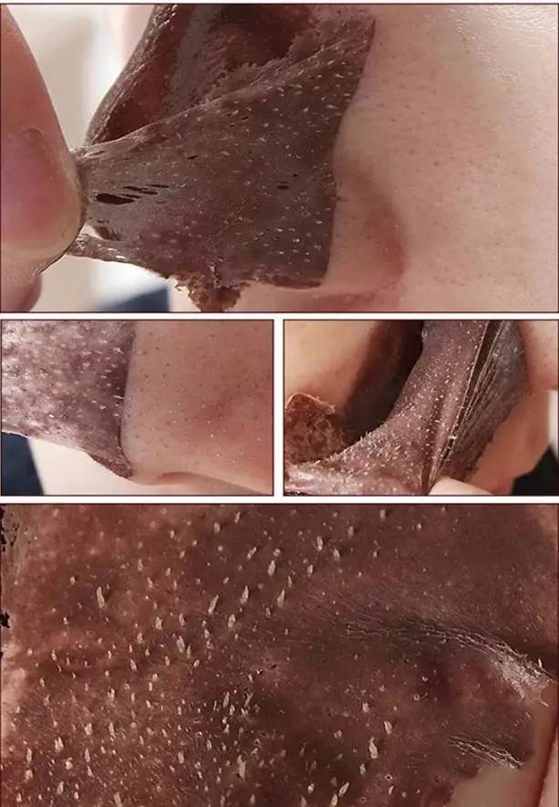 “黑头”这个渣男，彻底和他Say byebye~