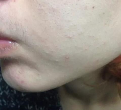 脸上摸起来硬硬的包但看不出来,脸上很多摸起来的痘痘