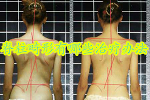 脊柱畸形有哪些常见的治疗办法