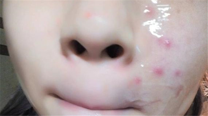 脸上有痘能够用芦荟胶吗 (完美芦荟胶能够去除脸上的痘吗)