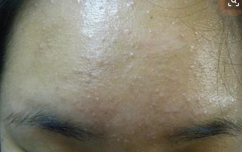 脸上摸起来硬硬的包但看不出来,脸上很多摸起来的痘痘