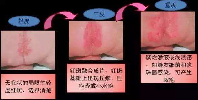 尿布疹跟妈妈的饮食有关吗,宝宝尿布疹有没有偏方治疗