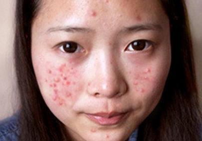 脸颊两侧下颚处长痘身体原因,女人脸颊两侧长痘的原因图片