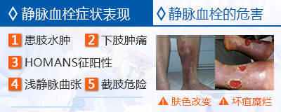 静脉血栓栓塞预防和治疗行家共识,静脉血栓防治的题目