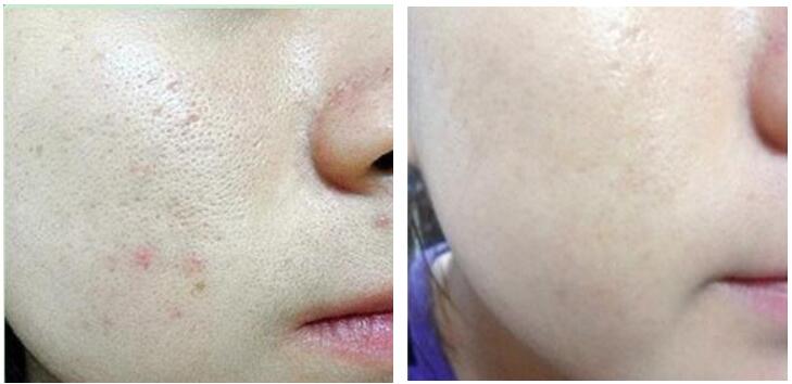 点阵激光能够解决皮肤老化吗,激光点阵和射频