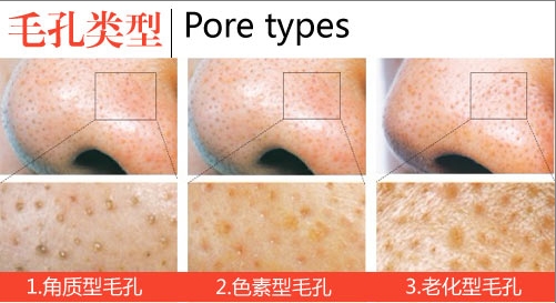 点阵激光能够解决皮肤老化吗,激光点阵和射频