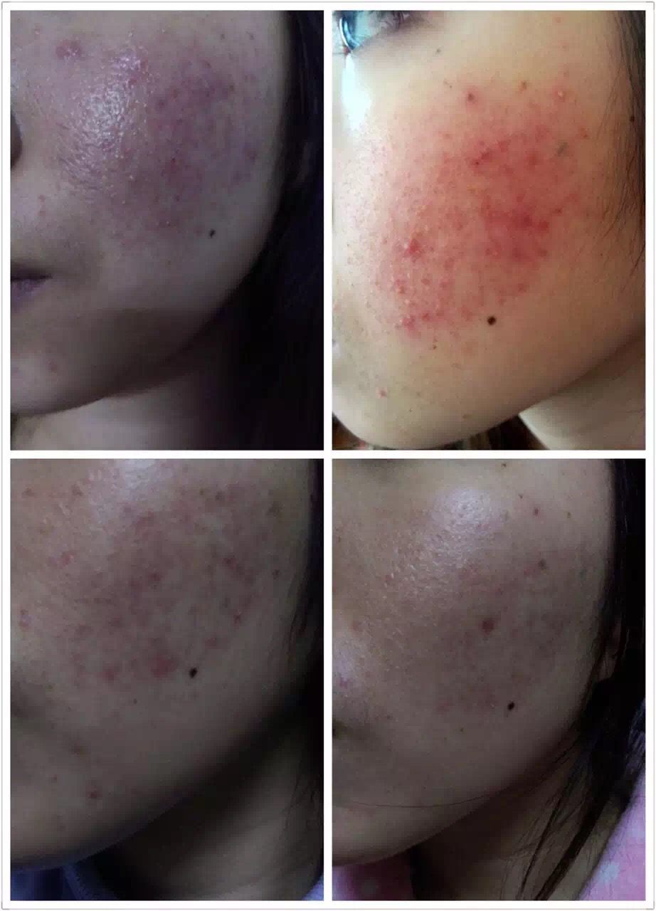 慎入！春季多发激素脸！你还要不要脸？