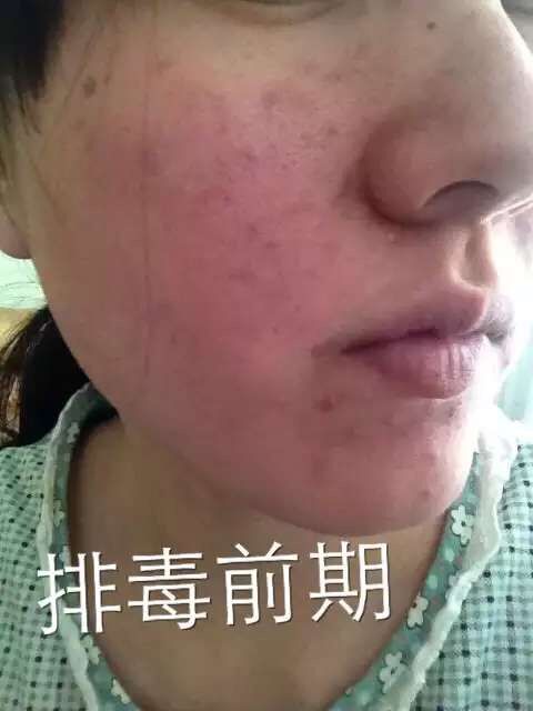 慎入！春季多发激素脸！你还要不要脸？