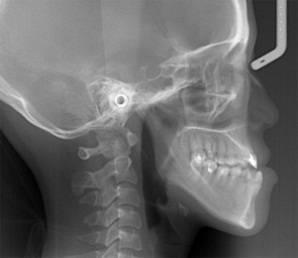 龅牙地包天怎么弄,龅牙怎么解决最好