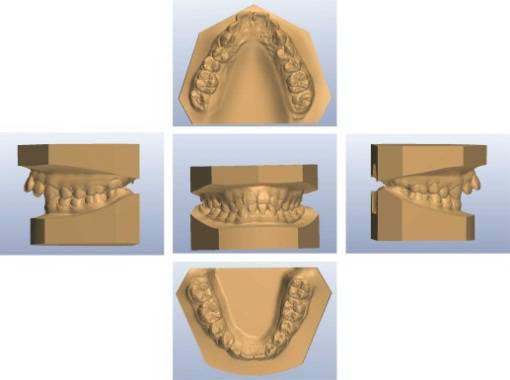 龅牙地包天怎么弄,龅牙怎么解决最好