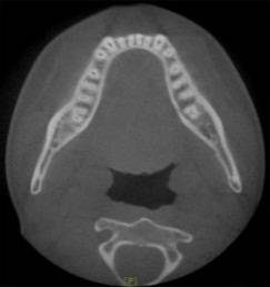 龅牙地包天怎么弄,龅牙怎么解决最好